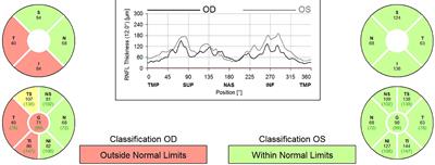 Novel treatments in optic pathway gliomas